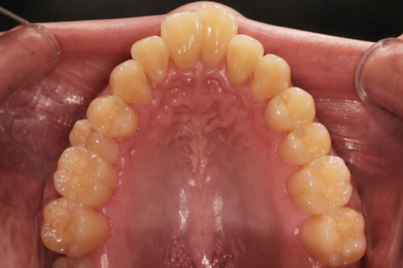구호흡 부정교합 유형