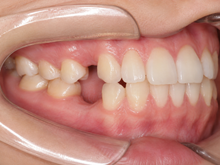 소구치 발치된 AI 이미지