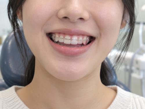 가철성 유지장치 착용  AI 이미지